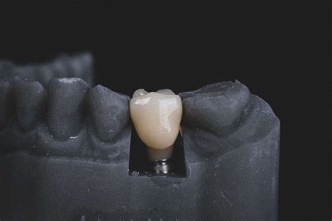 Titanium Biocompatibility For Medicine Applications Like Dental Implant