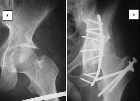 Digastric Trochanteric Flip Osteotomy And Surgical Dislocation Of Hip