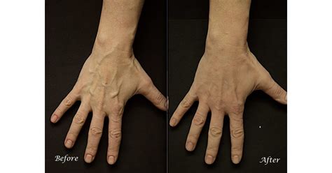 Bulging Hand Veins Permanently Removed With Rejuvahands™ Procedure