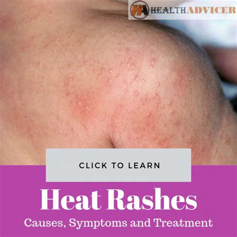Heat Rashes Causes Picture Symptoms Treatment And Prevention