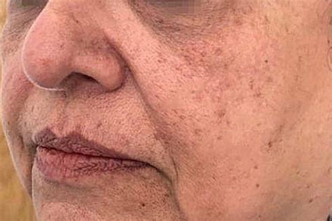 Nasolabial Folds And Marionette Lines Treatments Dr Yusra