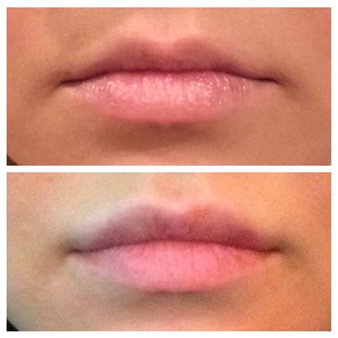 Before And After Juvederm Xc Lip Injections To My Top Lip The Bottom