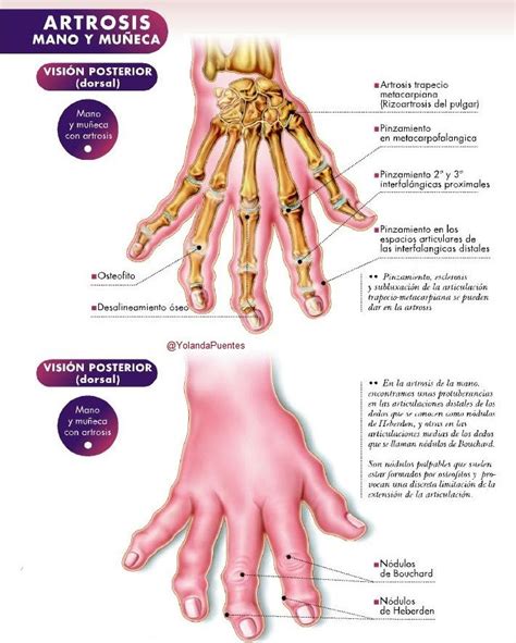 Artrosis De La Mano Signos Anatomía Traumatología Salud Y Deporte