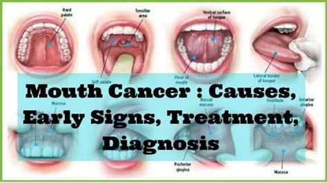 Beginning Of Mouth Cancer Find Out Oral Cancer Symptoms And Combat