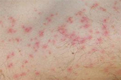 Red Spots On Skin Itchy Small Pictures Causes And Treatment