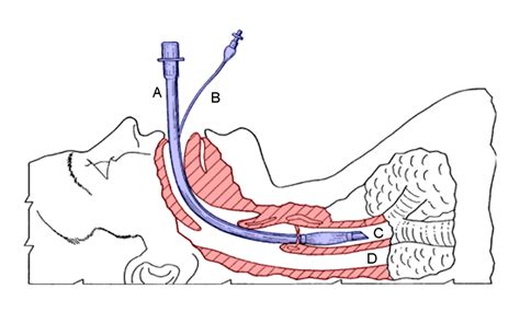 Endotrachealtubecolored Critical Care Practitioner