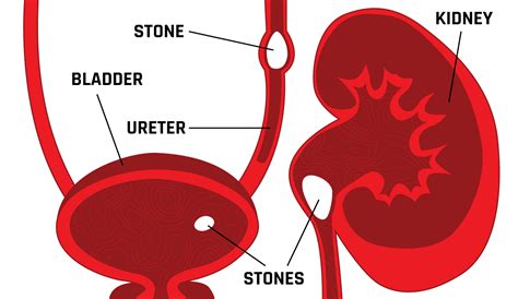Kidney Stones Overview Stone Relief
