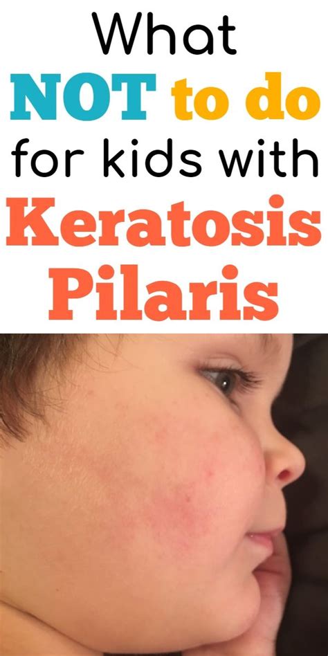 Keratosis Pilaris Treatment What Not To Do For Kp Skin Kids Dry