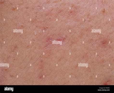 Acne On Facial Skindermatological Disease Acne Stock Photo Alamy