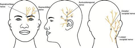 Multiple Cranial Nerve Blocks For The Transitional Treatment Of Chronic