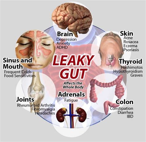 Leaky Gut Symptoms And Treatment Sydney Gp