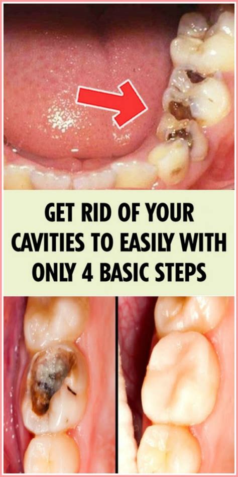 get rid of your cavities to easily with only 4 basic steps cavities healthy tips precision