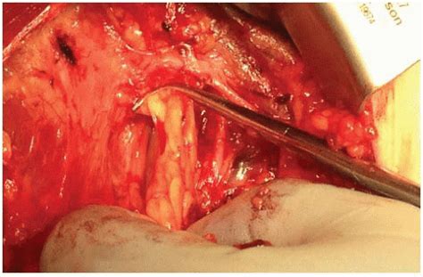 Axillary Lymph Node Dissection For Melanoma Basicmedical Key