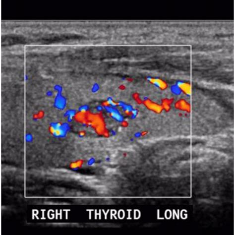 Thyroid Nodule With Taller Than Wide Dimensions Download Scientific