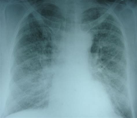 Pulmonary Edema X Ray Chest Pa View All About Cardiovascular System