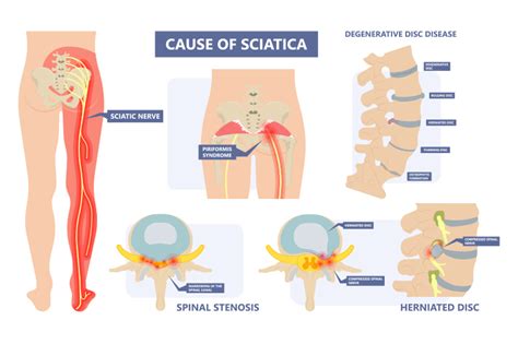 Sciatica And Piriformis Syndrome The Orthopedic Pain Institute