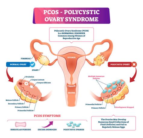 240 Polycystic Ovary Syndrome Stock Illustrations Royalty Free Vector Graphics And Clip Art Istock