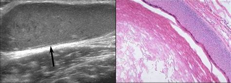 Groin Masses A 42 Year Old Man With Epidermoid Cyst A Longitudinal