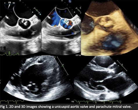 Late Diagnosis Of A Unicuspid Aortic Valve In A Patient With Repaired