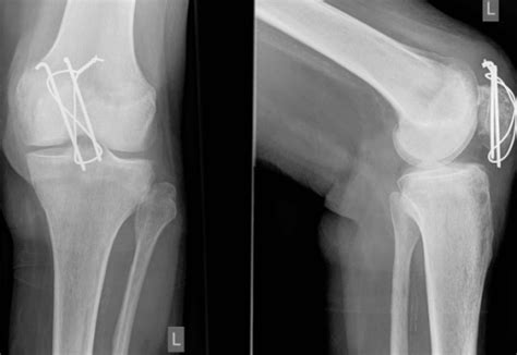 Anteroposterior And Lateral Radiographs Of Left Knee 3 Open I