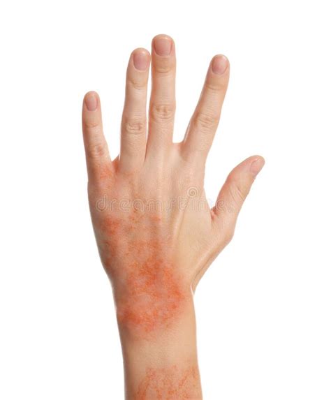 Woman Showing Hand With Dry Skin On White Background Closeup Stock
