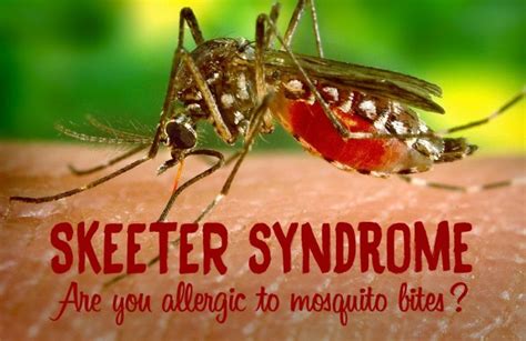 Skeeter Syndrome Symptoms And Best Remedies For Mosquito Bites