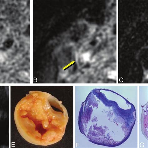 Imaging Of Carotid Plaque Containing Mainly Lipid Andor Necrosis