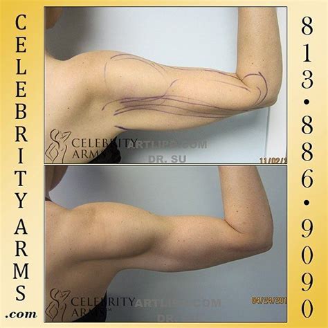 Arms Celebrity Arms Lipo Before After Photos