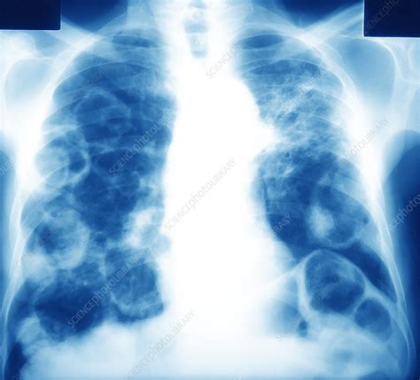Most primary lung tumors are a type of cancer called carcinoma. Secondary lung cancer, X-ray - Stock Image - M134/0639 ...