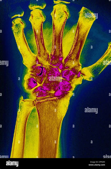 Wrist Osteoarthritis X Ray Stock Photo Alamy