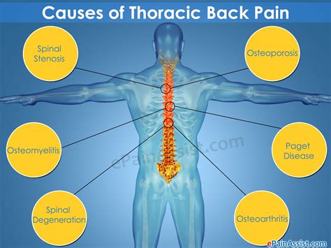 Lowering Blood Sugar Back Pain Thoracic Causes