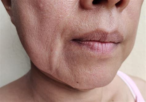 The Flabbiness Adipose Sagging Skin Beside The Mouth Wrinkles And