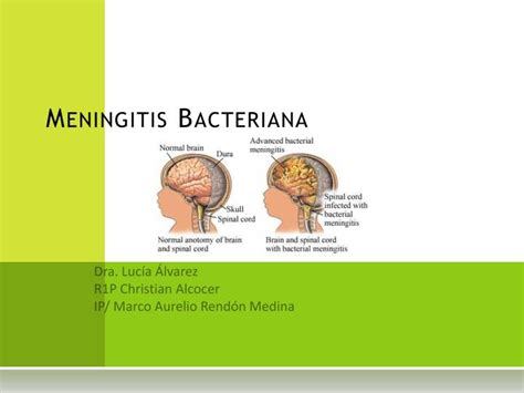 Ppt Meningitis Bacteriana Powerpoint Presentation Free