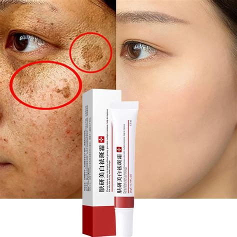 Creme Hidratante Clareador Facial Remova Freckle E Pontos Escuros Desbota Cicatrizes De Acne