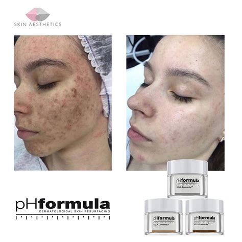 The Benefits Of Facials For Post Inflammatory Hyperpigmentation