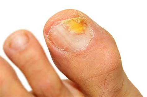 Split Toenails Causes And Treatment