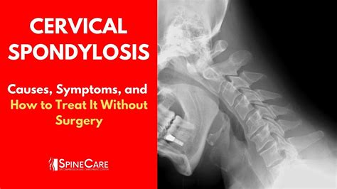 Cervical Spondylosis Causes Symptoms And Treatment No Surgery Youtube