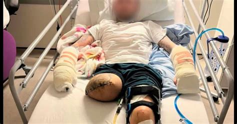 Man Mocks Gang Who Chopped His Leg And Fingers Off With A Machete From