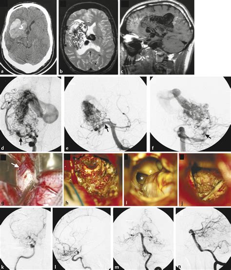 Four parallel pathways exist within the bg which participate in. Arteriovenous Malformations of the Basal Ganglia and ...