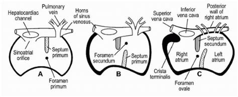 Percutaneous Transcatheter Closure Of Patent Foramen Ovale Thoracic Key