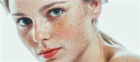 Best Freckles Removal Treatments Say Hello To Flawless Skin Medlinks