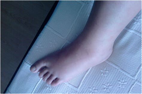 Scielo Brasil Eosinophilic Fasciitis An Atypical Presentation Of A