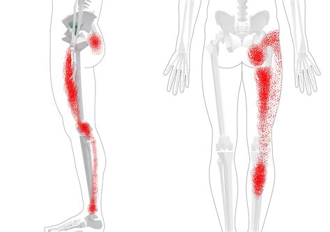 Tibialis Posterior Trigger Points Overview Self Treatment Tips