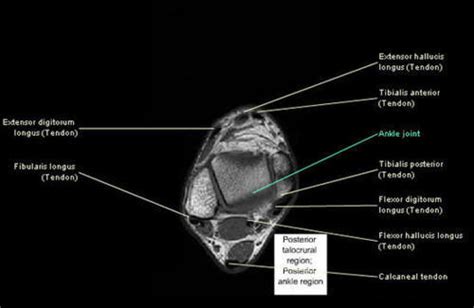 The intrinsic foot muscles comprise four layers of small muscles that have both their origin and insertion attachments within the foot. RADIOLOGY Review / Important Tendons of the Ankle