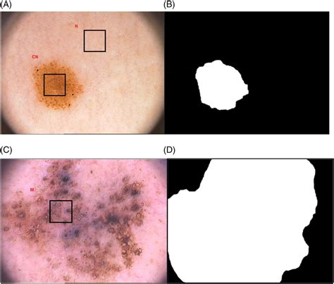 Two Dermoscopic Images Of Lesions And Their Segmentation Showing A