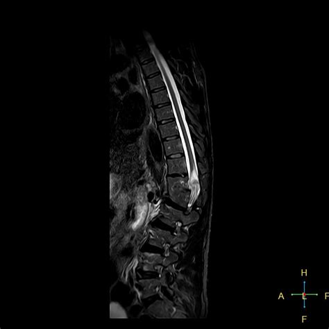 Chance fracture of T12 | Image | Radiopaedia.org