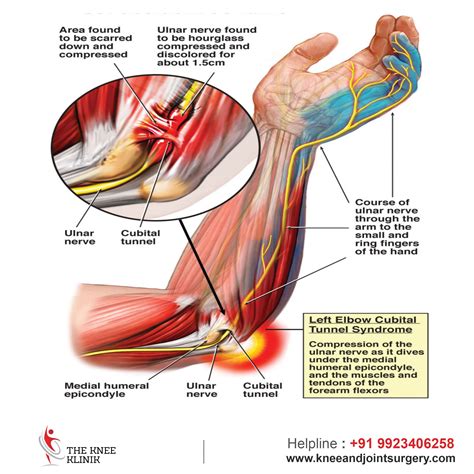 Cubitaltunnelsyndrome It Is A Condition Caused By Increased