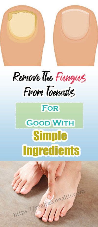 9 Ways To Remove The Fungus From Toenails For Good With Simple