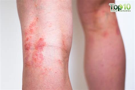Home Remedies For Inverse Psoriasis Top 10 Home Remedies
