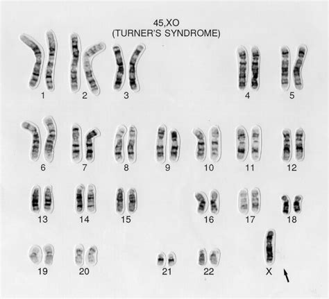 Turner S Syndrome Karyotype 45 XO This Female Lacks The Second X